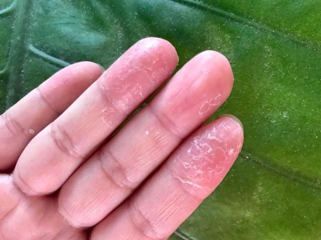 教你正確辨別手廯與濕疹